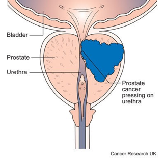 prostate-symptoms