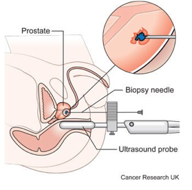prostate-test2
