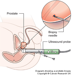 prostate-tests
